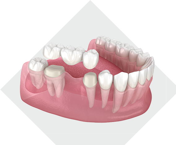 Dental Bridges in Dental Providence RI